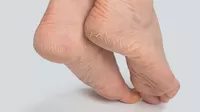 El remedio más eficaz para acabar con las grietas de los pies